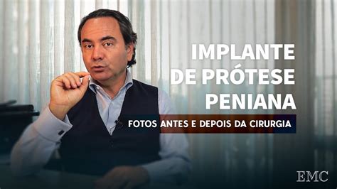 Prótese Peniana: Fotos antes e depois da cirurgia